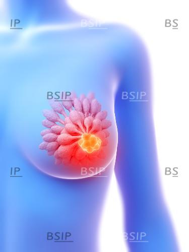Illustration of mammary gland tumour