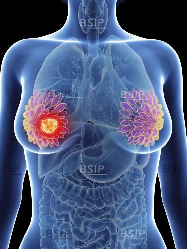 Illustration of a woman's mammary glands cancer