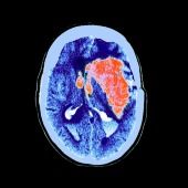 Brain haemorrhage, MRI scan