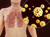 Infection pulmonaire à coronavirus, ill...